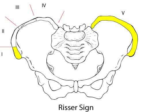 risser sign